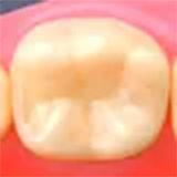 ハイブリッドCR（直接法）